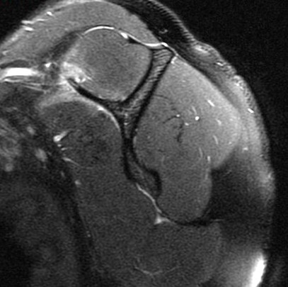 Figure 4 for case scapular fracture and supraspinatus and subscapularis muscle strain ( RID1860 ) ( RID1870 )